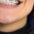 What is the meaning of cosmetic orthodontic appliances?