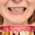 What are the best cosmetic teeth?