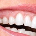 Does a Cosmetic Dentist Make Fillings?