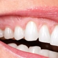 Does the cosmetic dentist make fillings?