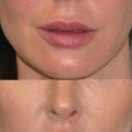 Do Dentists Offer Lip Augmentation Services?