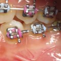 Are Orthopedic Braces a Cosmetic Treatment?