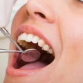 How to Find the Right Cosmetic Dentist