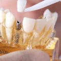 The Best Cosmetic Dentists in Turkey: Get Quality Dental Care at Affordable Prices