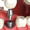 How Much Does It Cost to Have a Cosmetic Smile Makeover?
