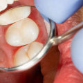 Cosmetic Dental Fillings: A Modern Solution to Unsightly Silver Amalgam Fillings