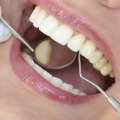 Are Fillings Considered Cosmetic Dentistry?