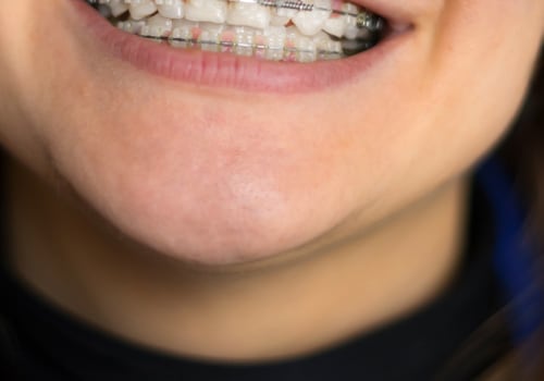 What is the meaning of cosmetic orthodontic appliances?