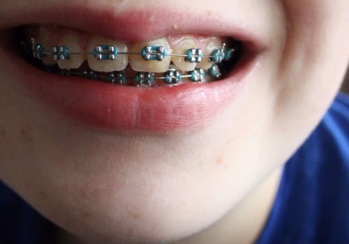 The Difference Between Orthodontists and Cosmetic Dentists