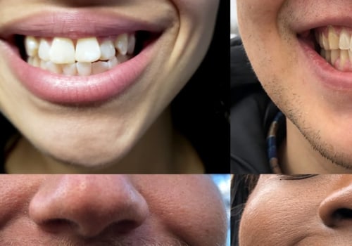 How Long Does a Smile Makeover Last?