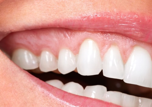 Does a Cosmetic Dentist Make Fillings?