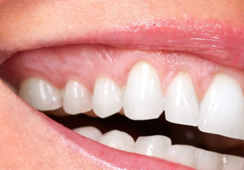 Does the cosmetic dentist make fillings?