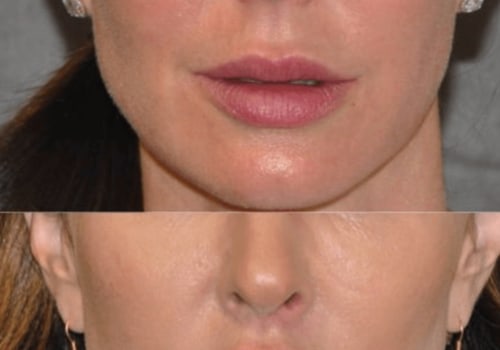 Do Dentists Offer Lip Augmentation Services?