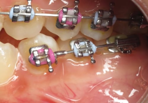 Are Orthopedic Braces a Cosmetic Treatment?