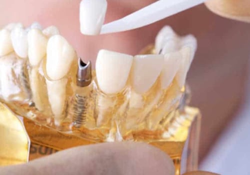 The Best Cosmetic Dentists in Turkey: Get Quality Dental Care at Affordable Prices