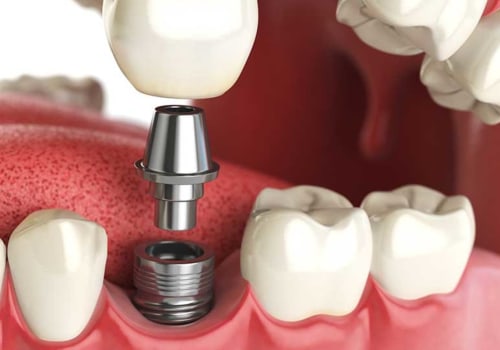 How Much Does It Cost to Have a Cosmetic Smile Makeover?