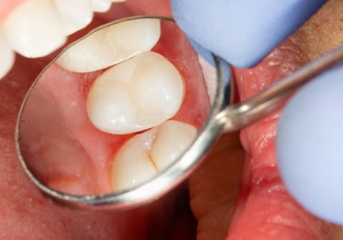Cosmetic Dental Fillings: A Modern Solution to Unsightly Silver Amalgam Fillings