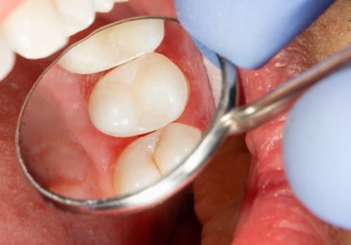 What is cosmetic dental filling?