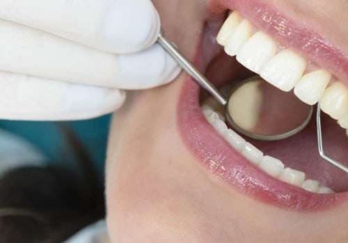 Are Fillings Considered Cosmetic Dentistry?